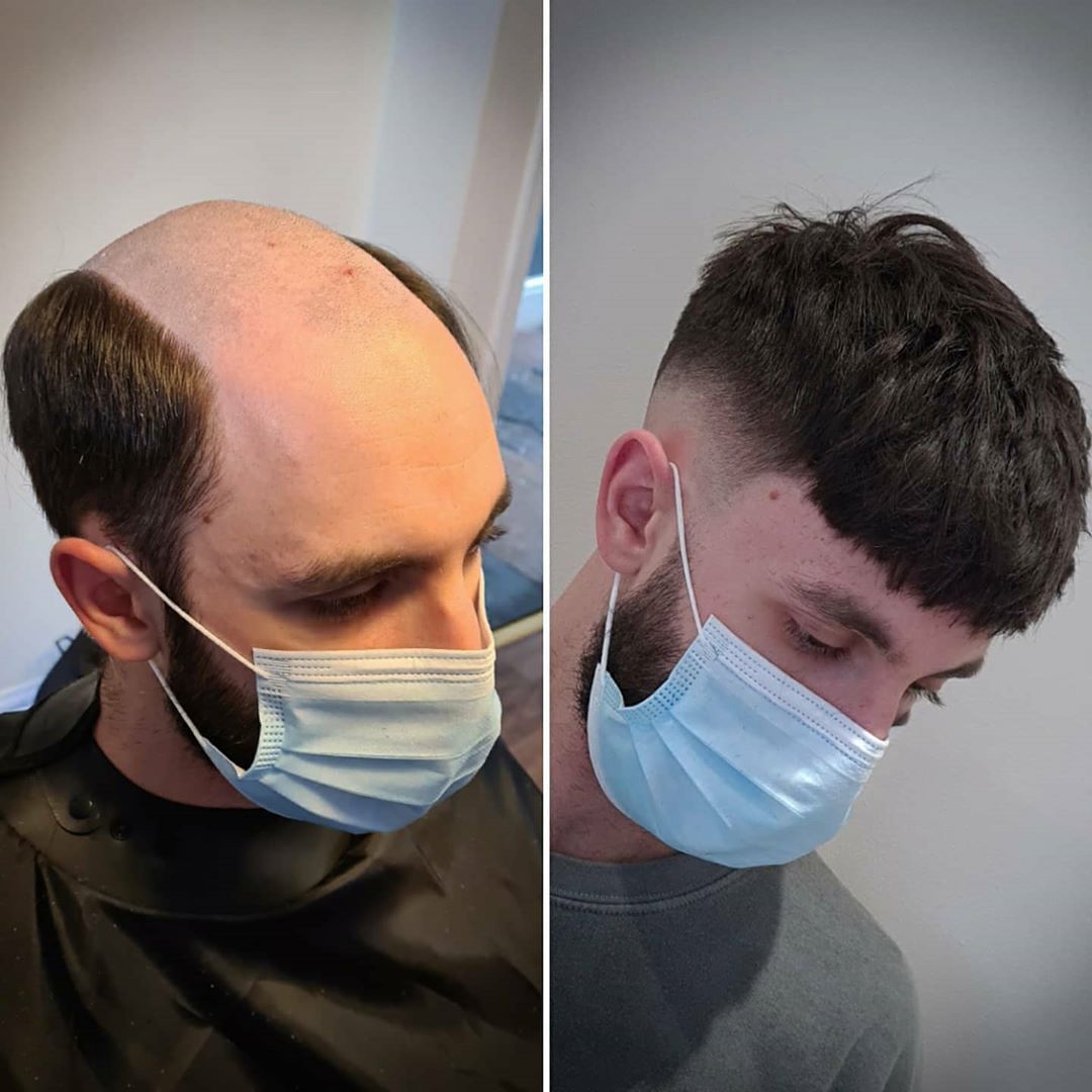Profesionales New Hair trabajando con discreción